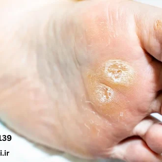 چسب میخچه یا محلول