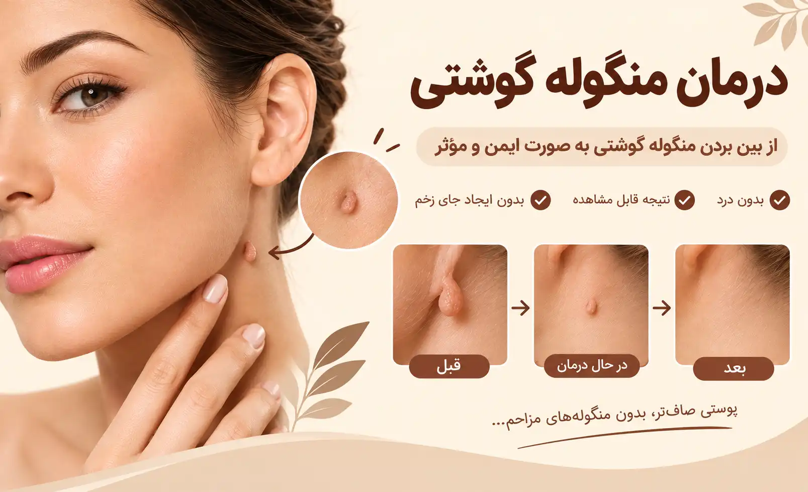 درمان منگوله گوشتی
